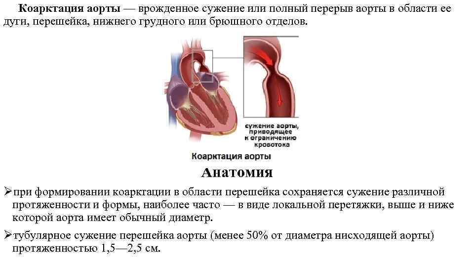  Коарктация аорты — врожденное сужение или полный перерыв аорты в области ее дуги,