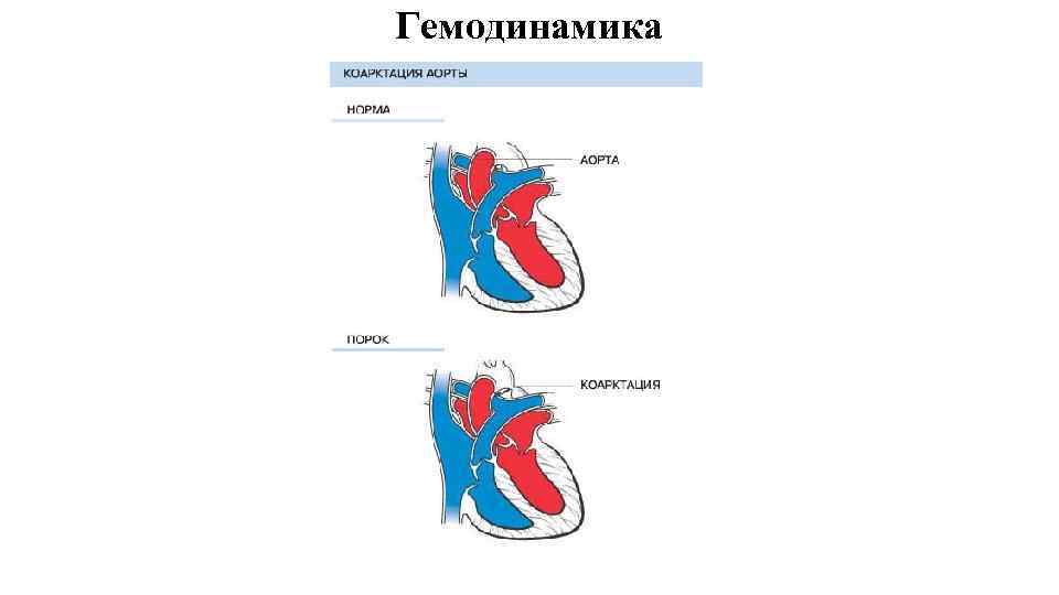 Коарктация аорты гемодинамика схема