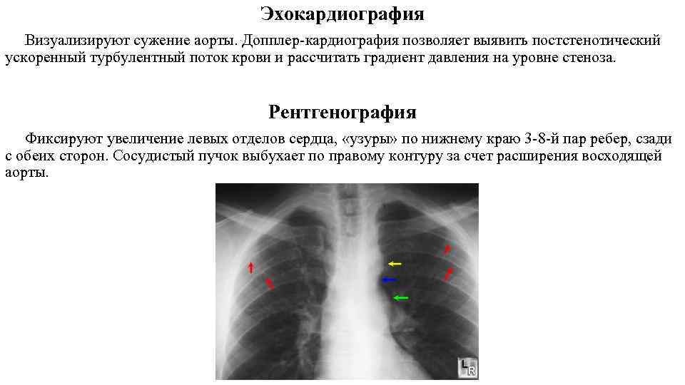 Эхокардиография Визуализируют сужение аорты. Допплер кардиография позволяет выявить постстенотический ускоренный турбулентный поток крови и