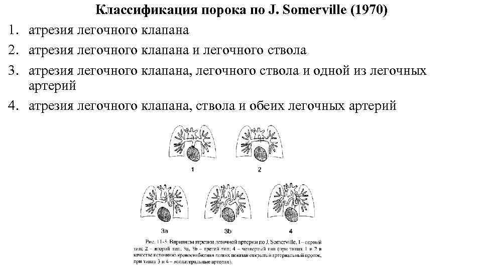 1. 2. 3. 4. Классификация порока по J. Somerville (1970) атрезия легочного клапана и