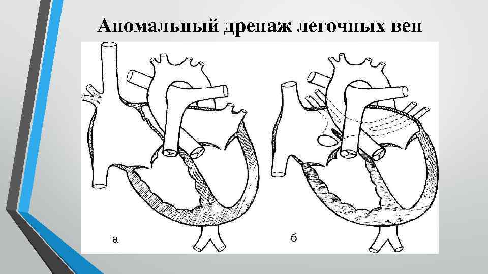 Аномальный дренаж легочных вен 