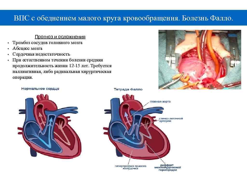 ВПС с обеднением малого круга кровообращения. Болезнь Фалло. • • Прогноз и осложнения Тромбоз