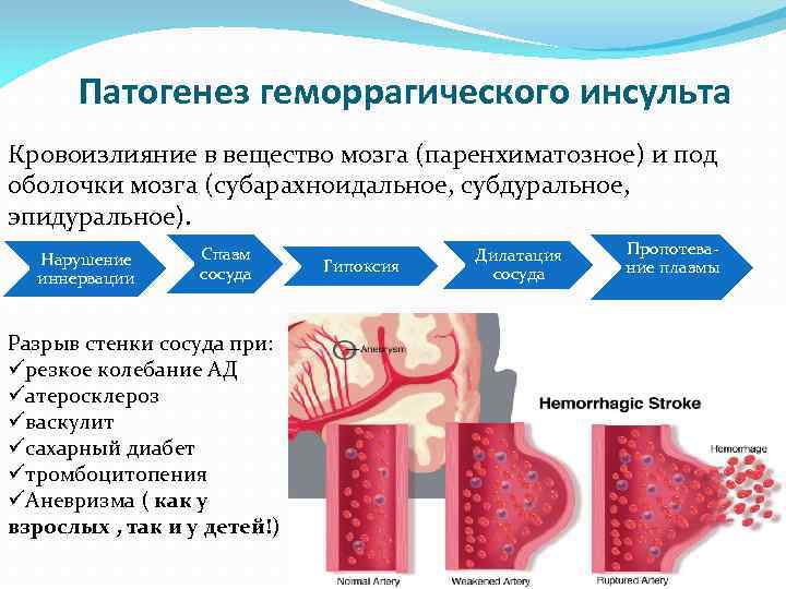Патогенез геморрагического инсульта Кровоизлияние в вещество мозга (паренхиматозное) и под оболочки мозга (субарахноидальное, субдуральное,