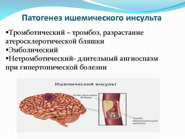 Патогенез ишемического инсульта §Тромботический – тромбоз, разрастание атеросклеротической бляшки §Эмболический §Нетромботический- длительный ангиоспазм при