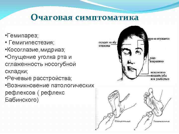 Очаговая симптоматика • Гемипарез; • Гемигипестезия; • Косоглазие, мидриаз; • Опущение уголка рта и