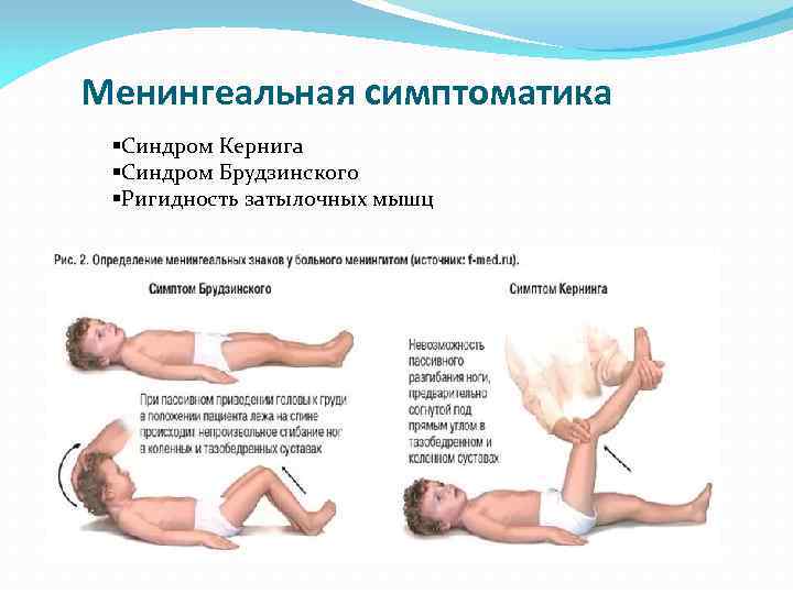 Менингеальная симптоматика §Синдром Кернига §Синдром Брудзинского §Ригидность затылочных мышц 
