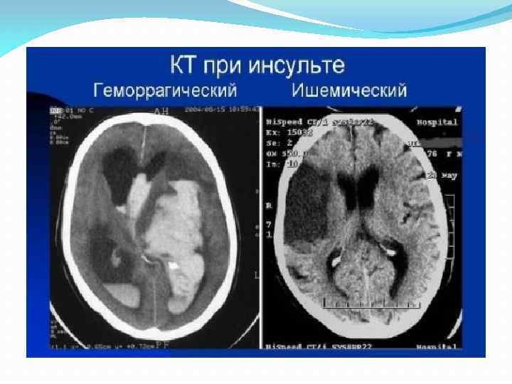 Ишемический инсульт и геморрагический инсульт картинки