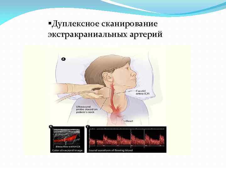 §Дуплексное сканирование экстракраниальных артерий 