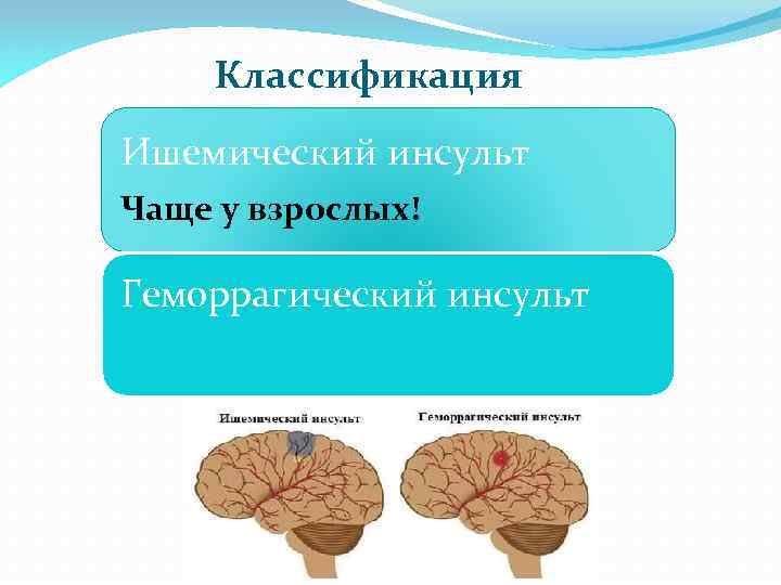 Классификация Ишемический инсульт Чаще у взрослых! Геморрагический инсульт 