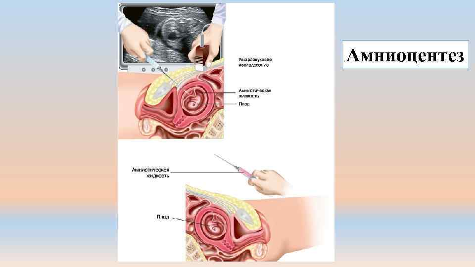 Амниоцентез 