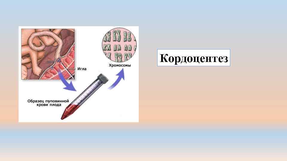 Кордоцентез 