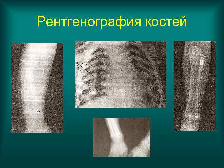 Рентгенография костей 