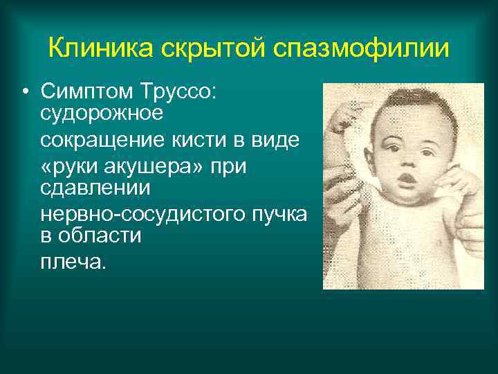 Клиника скрытой спазмофилии • Симптом Труссо: судорожное сокращение кисти в виде «руки акушера» при