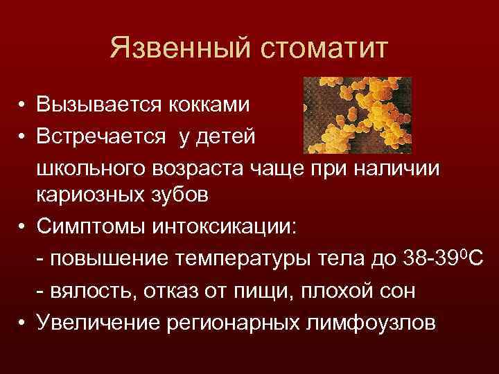 Язвенный стоматит • Вызывается кокками • Встречается у детей школьного возраста чаще при наличии