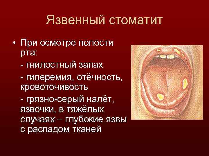 Язвенный стоматит • При осмотре полости рта: - гнилостный запах - гиперемия, отёчность, кровоточивость