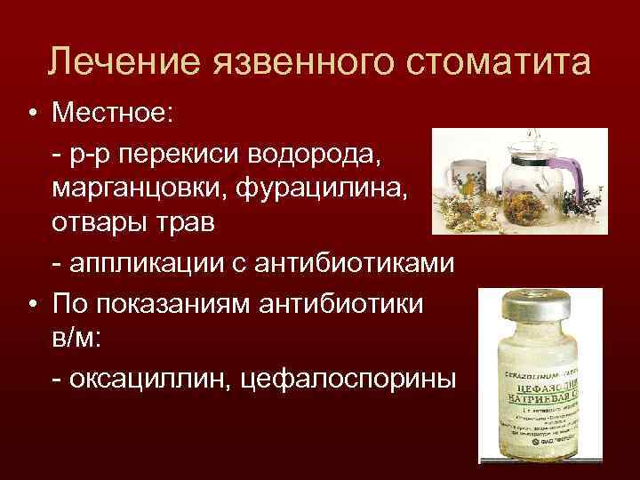 Лечение язвенного стоматита • Местное: - р-р перекиси водорода, марганцовки, фурацилина, отвары трав -