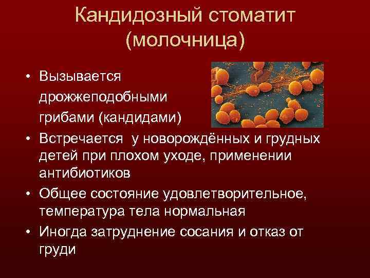 Кандидозный стоматит (молочница) • Вызывается дрожжеподобными грибами (кандидами) • Встречается у новорождённых и грудных