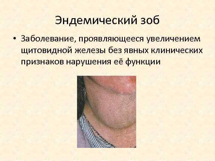 Эндемический зоб • Заболевание, проявляющееся увеличением щитовидной железы без явных клинических признаков нарушения её
