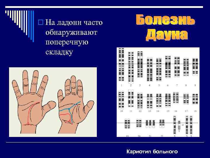 o На ладони часто обнаруживают поперечную складку Кариотип больного 