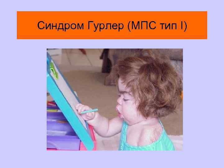 Синдром Гурлер (МПС тип I) 