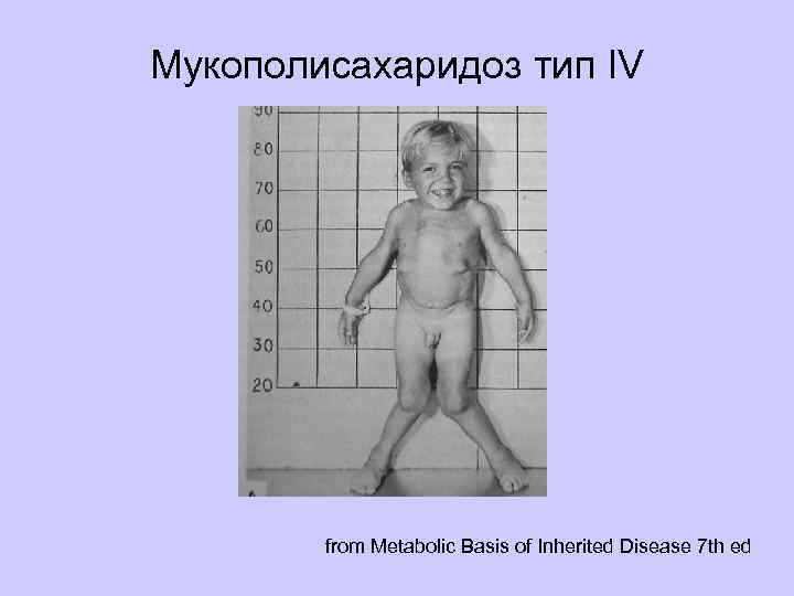 Мукополисахаридоз тип IV from Metabolic Basis of Inherited Disease 7 th ed 