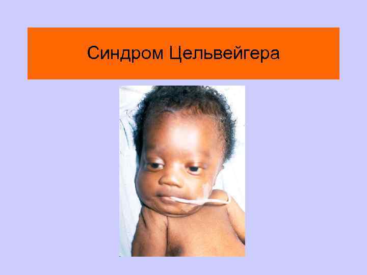 Синдром Цельвейгера 