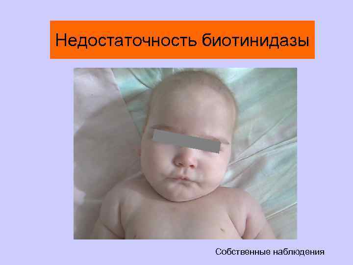 Недостаточность биотинидазы Собственные наблюдения 