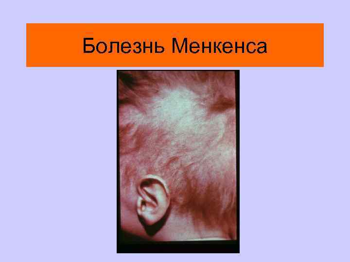 Болезнь Менкенса 