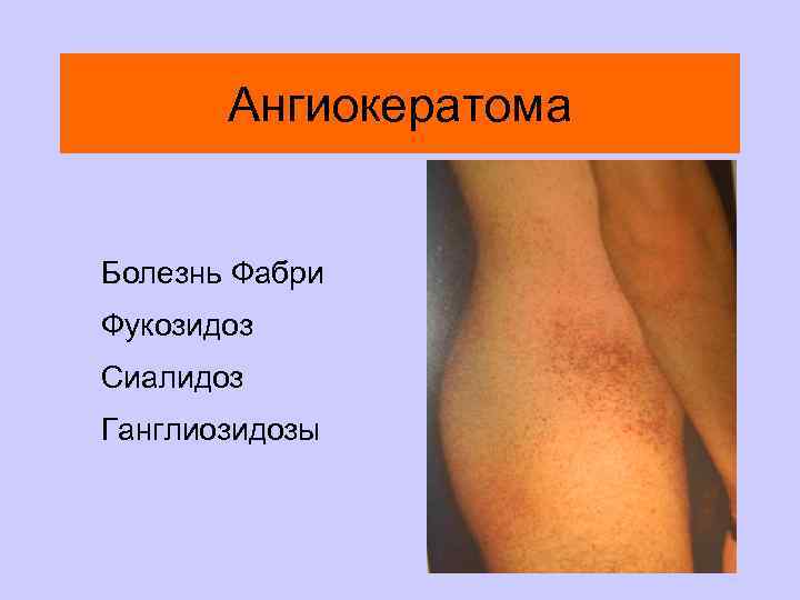 Ангиокератома Болезнь Фабри Фукозидоз Сиалидоз Ганглиозидозы 