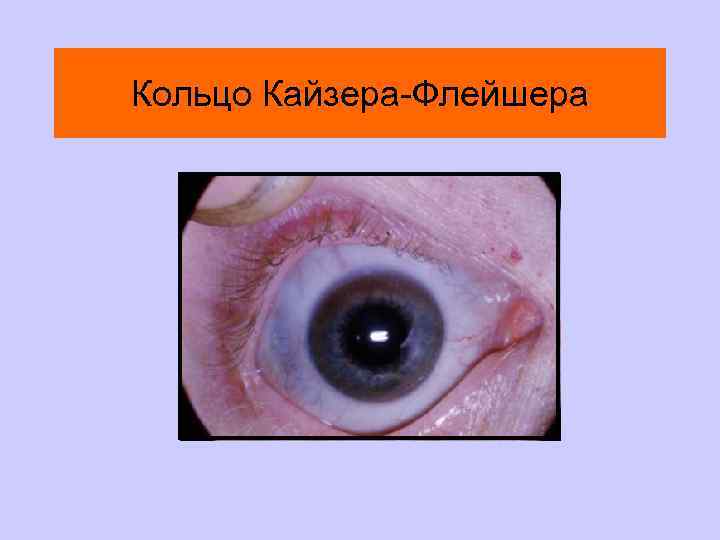 Кольцо Кайзера-Флейшера 