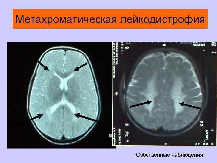 Метахроматическая лейкодистрофия Собственные наблюдения 