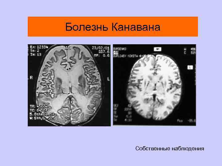 Болезнь Канавана Собственные наблюдения 