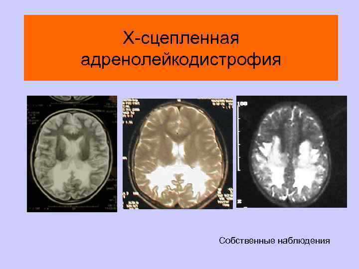 Х-сцепленная адренолейкодистрофия Собственные наблюдения 