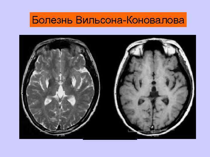 В клинической картине болезни вильсона специфично