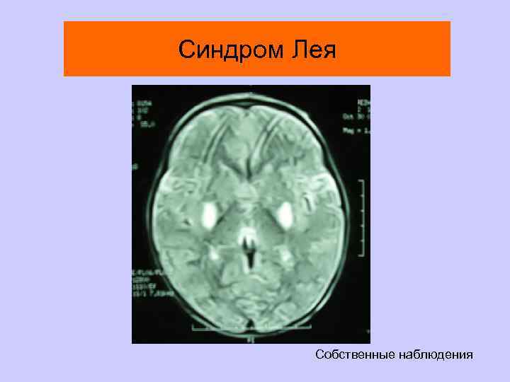 Синдром Лея Собственные наблюдения 