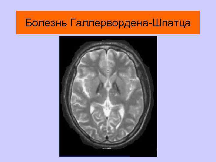 Болезнь Галлервордена-Шпатца 