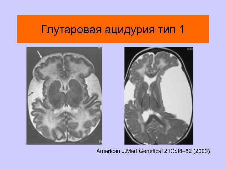 Глутаровая ацидурия тип 1 American J. Med Genetics 121 C: 38– 52 (2003) 