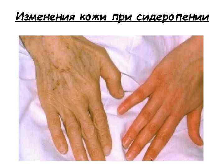 Изменения кожи при сидеропении 