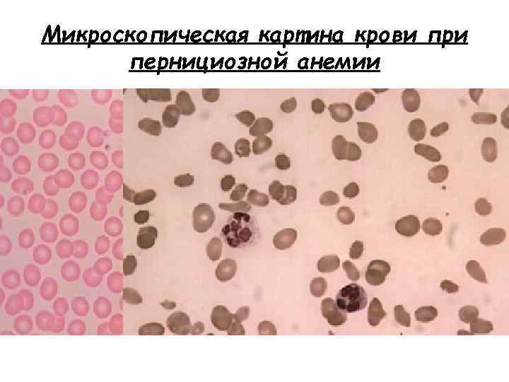 Микроскопическая картина крови при пернициозной анемии 