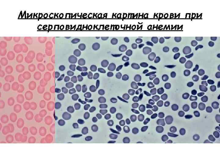 Микроскопическая картина крови при серповидноклеточной анемии 