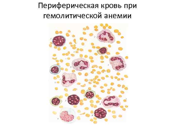 Периферическая кровь при гемолитической анемии 