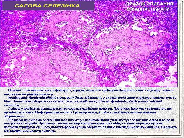 ЗРАЗОК ОПИСАННЯ МІКРОПРЕПАРАТУ Основні зміни виявляються в фолікулах, червона пульпа та трабекули зберігають свою