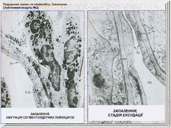 Порушення крово- та лімфообігу. Запалення. (Змістовний модуль № 2) № 2 