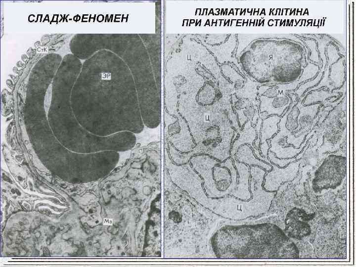 Сладж это. Сладж феномен патанатомия. Сладж феномен и монетные столбики. Сладж это в патологии.