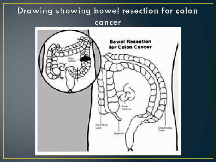 Drawing showing bowel resection for colon cancer 