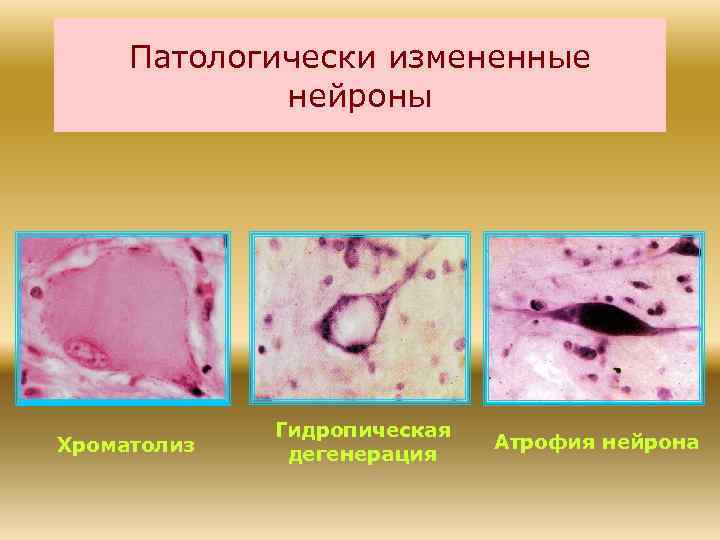 Патологически измененные нейроны Хроматолиз Гидропическая дегенерация Атрофия нейрона 