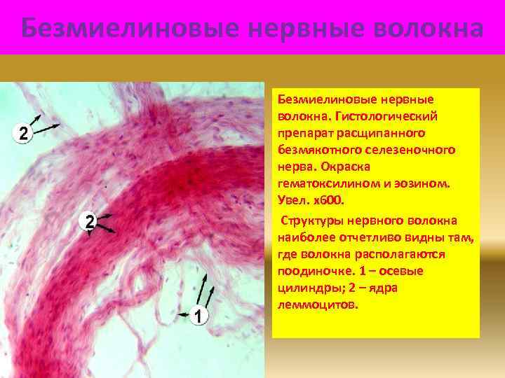 Безмиелиновые нервные волокна. Гистологический препарат расщипанного безмякотного селезеночного нерва. Окраска гематоксилином и эозином. Увел.