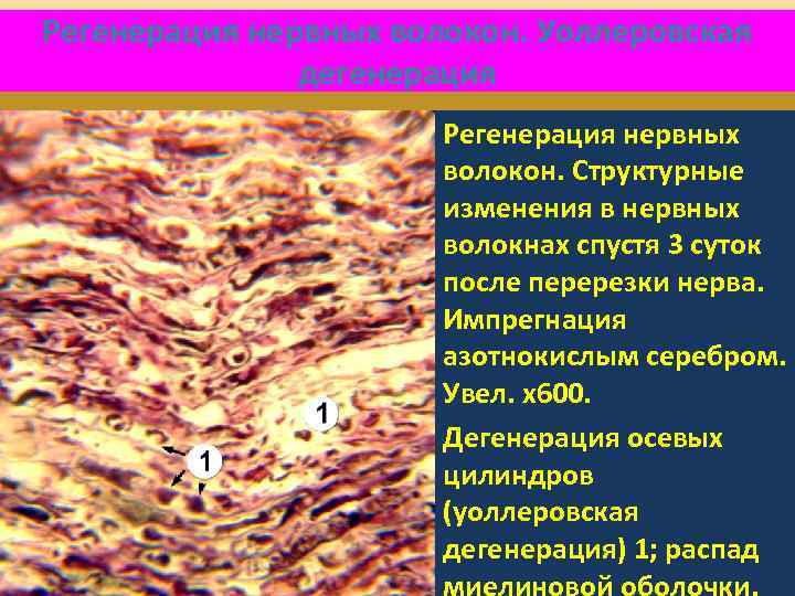 Регенерация нервных волокон. Уоллеровская дегенерация Регенерация нервных волокон. Структурные изменения в нервных волокнах спустя
