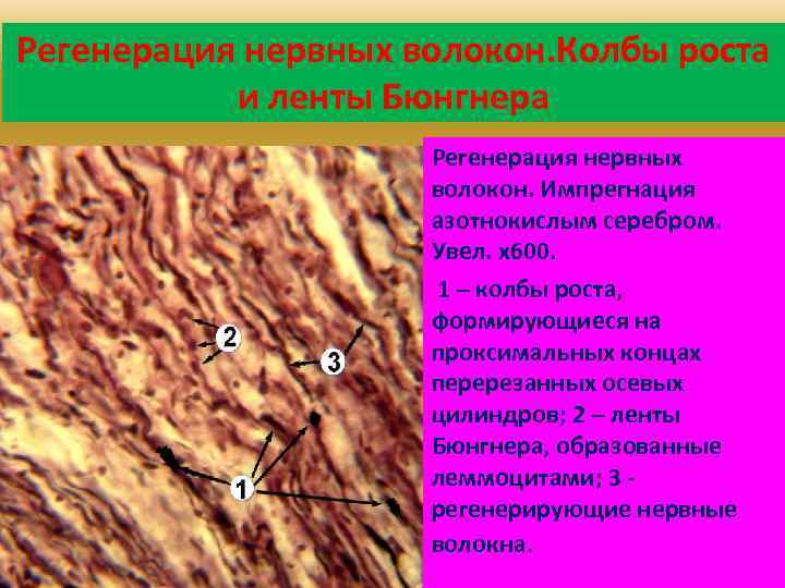 Аксонопатия моторных волокон