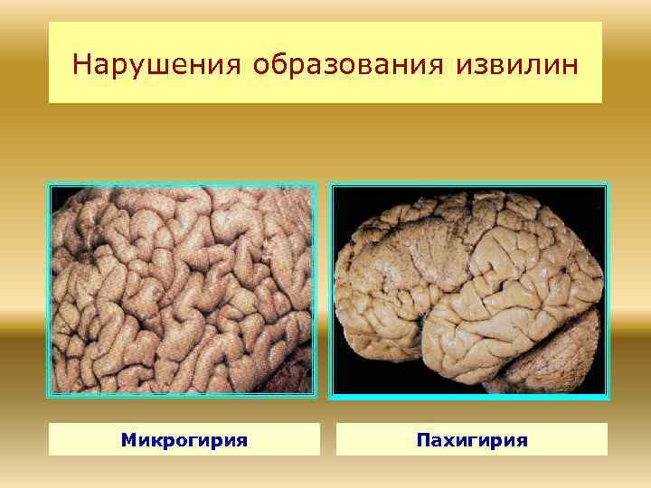 Нарушения образования извилин Микрогирия Пахигирия 